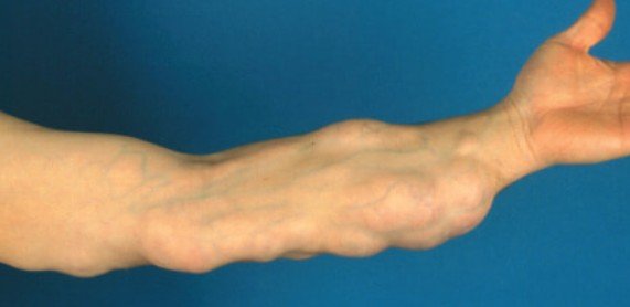 The Real Difference Between Dermal Fillers and Botox Treatments